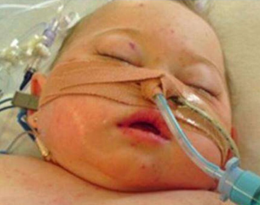 腦膜炎後遺症的