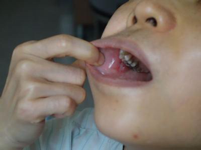 小孩子的口腔的淋巴結的發炎的