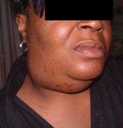 腮腺炎的症狀和