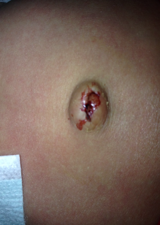 寶寶臍帶脫落後