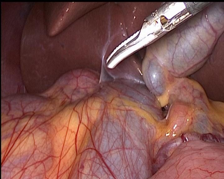 右側腎上腺腫瘤手術中的