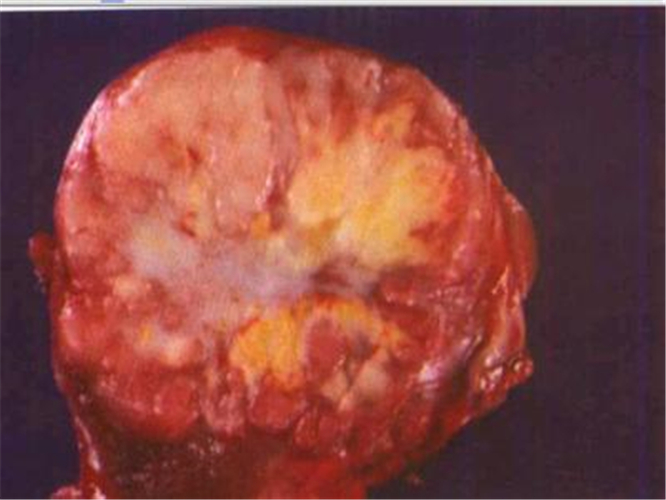 切除的甲狀腺癌