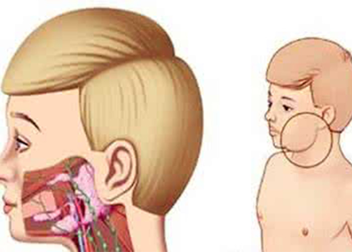 淋巴瘤症狀卡通