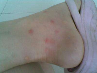 被跳蚤咬的症狀