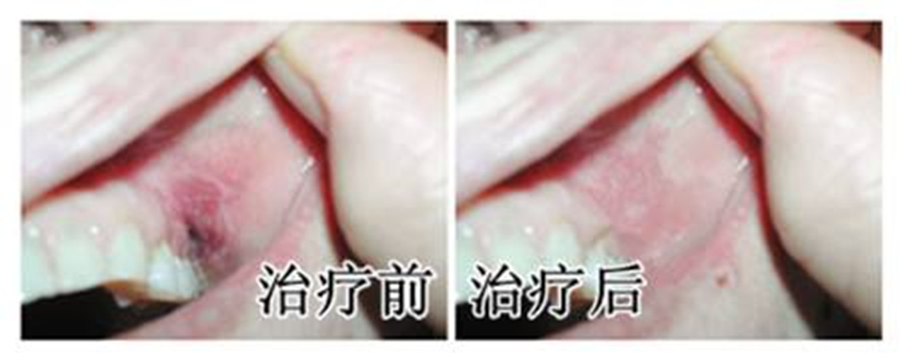 扁平苔蘚能治好嗎 