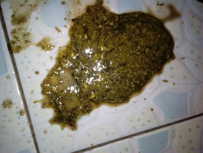 寶寶母乳性腹瀉大便呈黑褐色