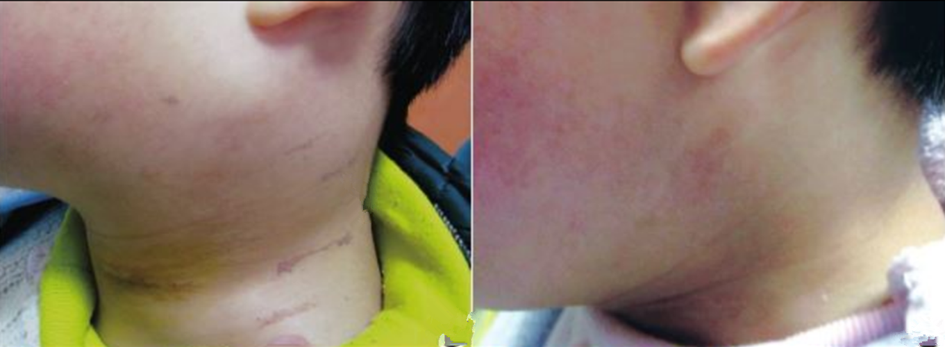 霍奇金淋巴瘤症狀體徵 