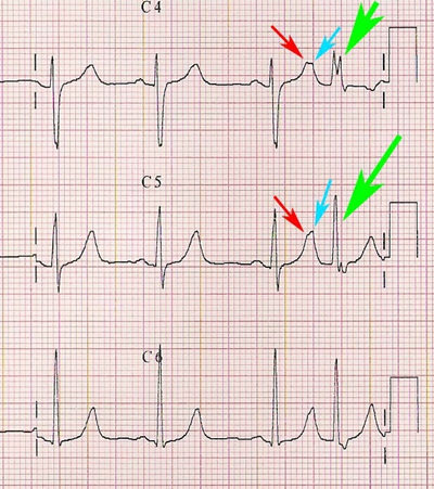 頻發房性早搏 (4) 