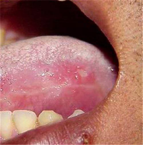 白塞病嘴唇下