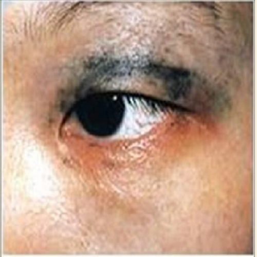 眼睛有太田痣
