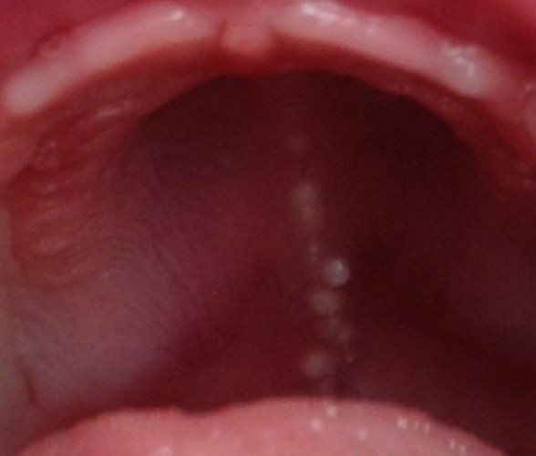 咽喉白色念珠菌感染 