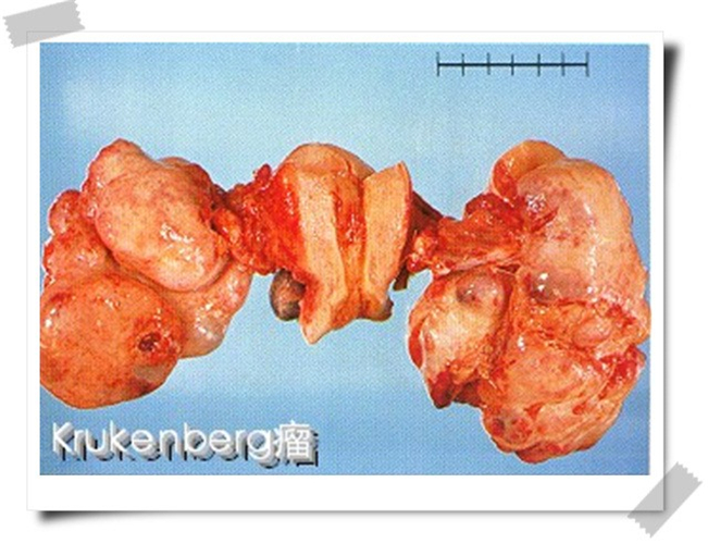 卵巢癌轉移的癌細胞瘤