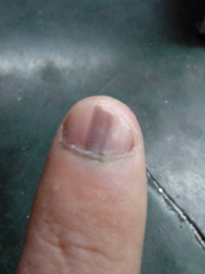 手指甲上有豎紋圖解 (35) 