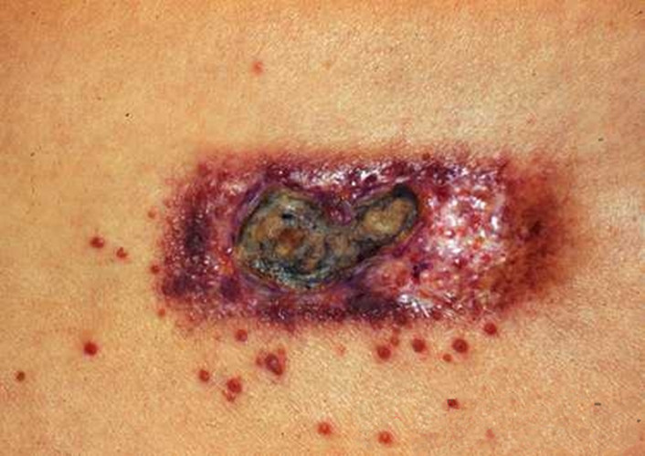 嚴重的放射性皮炎