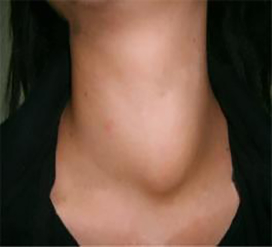 左側脖子甲狀腺腫大