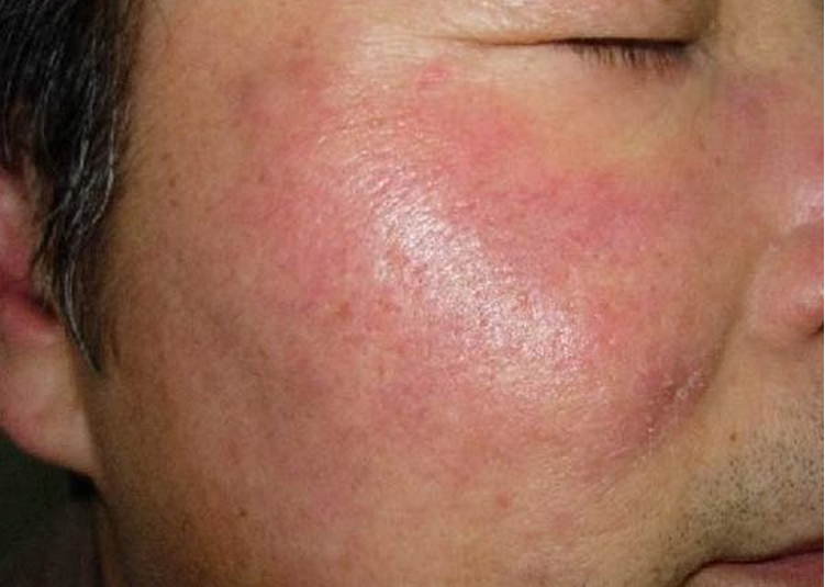 臉部日光性皮炎