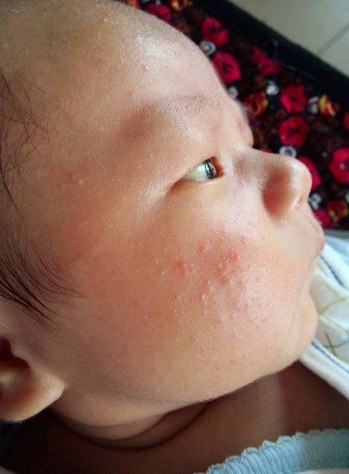 臉上皮膚過敏症狀