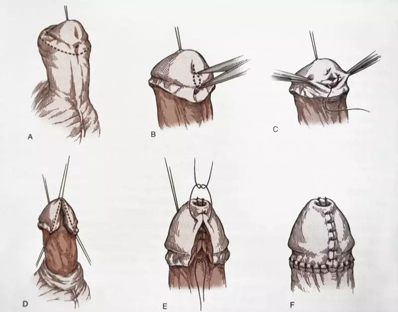 陰囊型尿道下裂