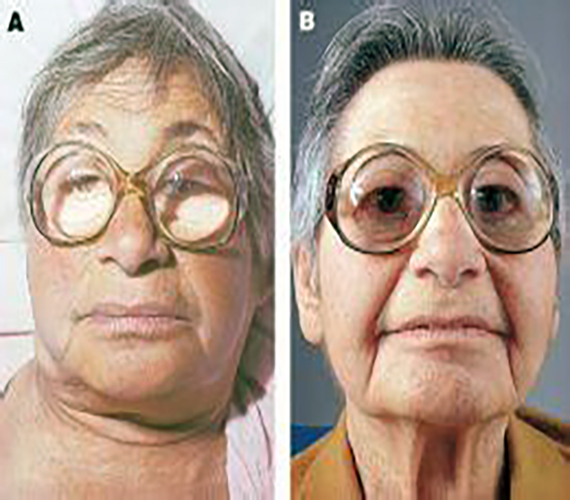 喬本氏甲狀腺炎