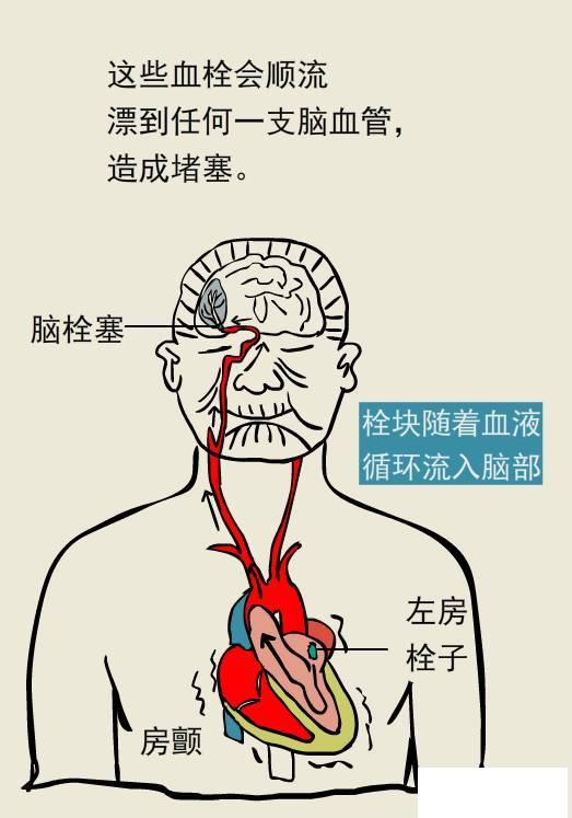 腦血栓是腦梗死最常見的類型 