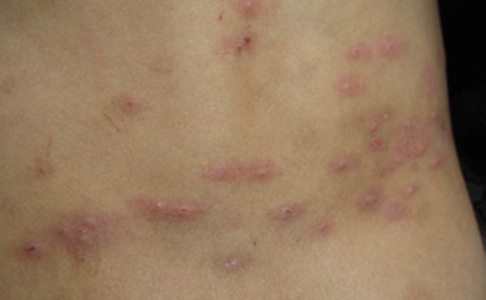 結節性癢疹 (45) 