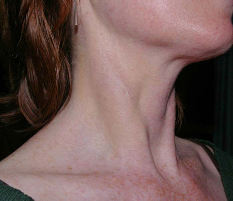 頸靜脈怒張 (49) 