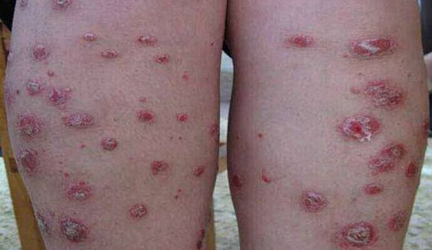 腫大的妊娠合併梅毒