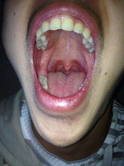 食道炎症狀 (43) 