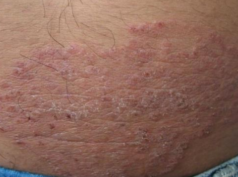 體股癬初期現象