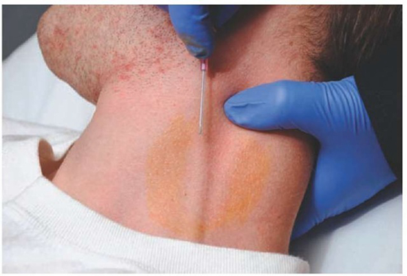 頸靜脈怒張 (38) 