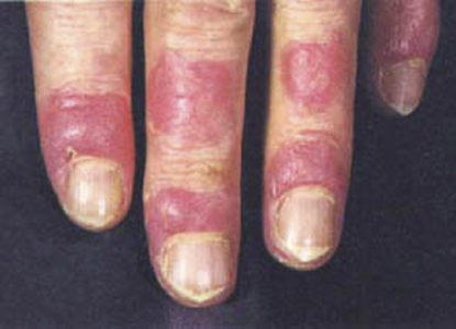 系統性紅斑狼瘡診斷標準 (49) 