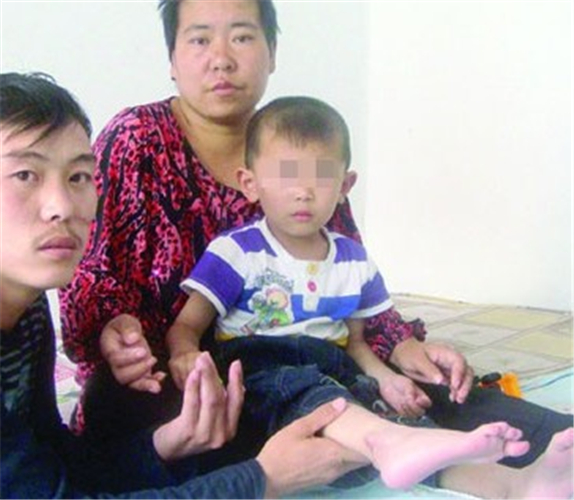 幼童右腿骨肉瘤