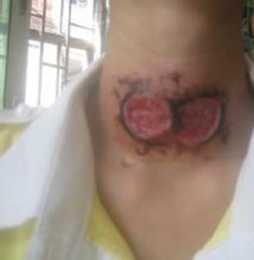 少年淋巴結核頜下