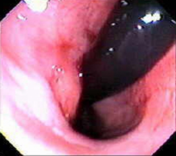 乙狀結腸癌未分化癌早期 症狀