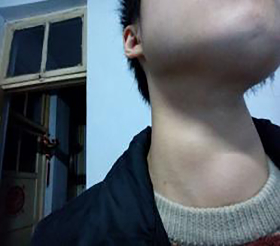 三度甲狀腺腫大的體徵