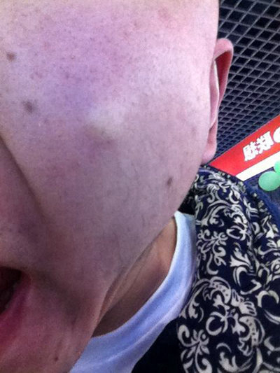 神經性皮炎的治療 (61) 