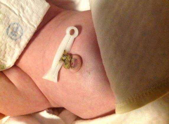 寶寶臍帶脫落後