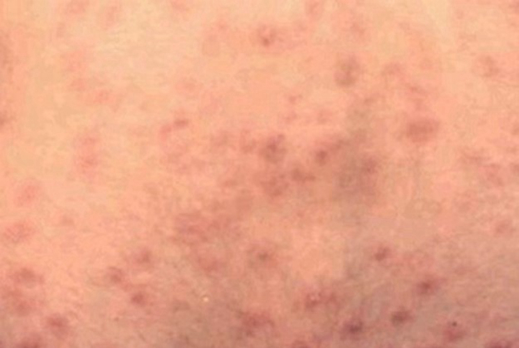 早期妊娠合併梅毒圖 