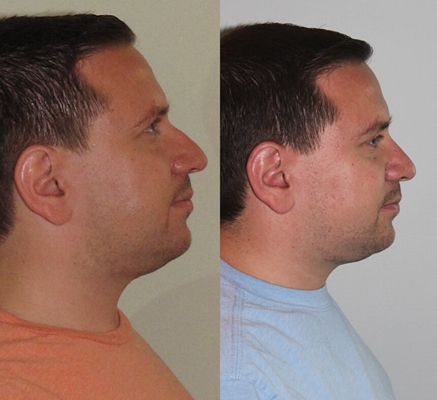 鼻中隔彎曲手術圖解 (47) 