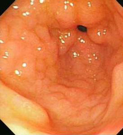 萎縮性慢性胃炎