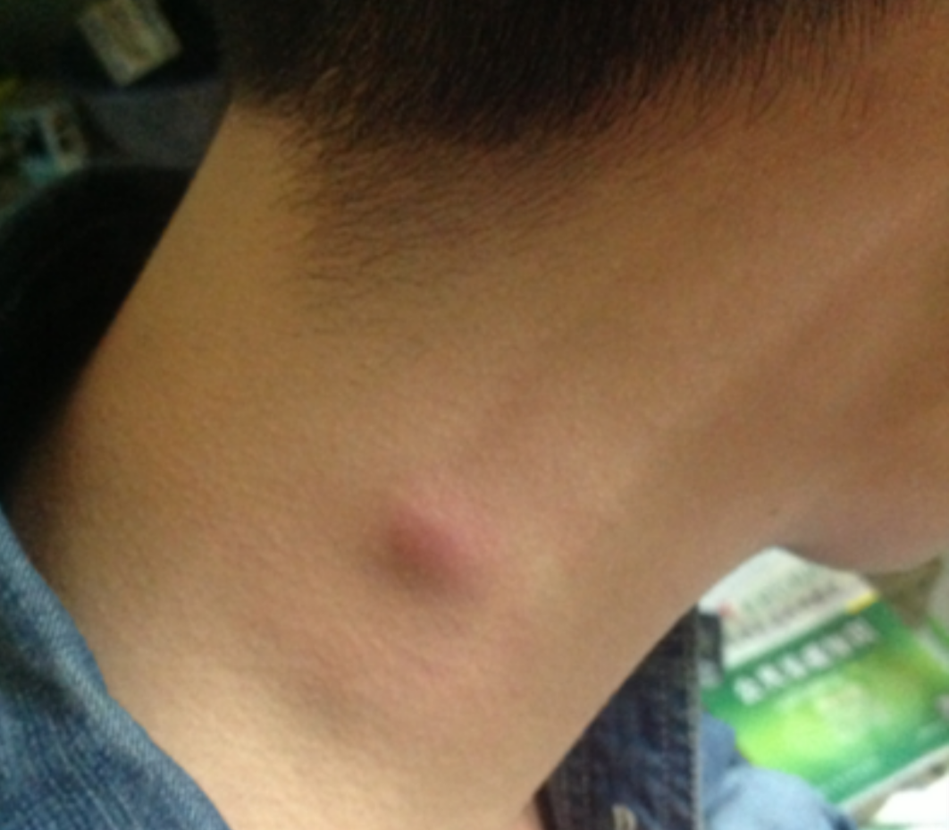 頸部淋巴瘤症狀