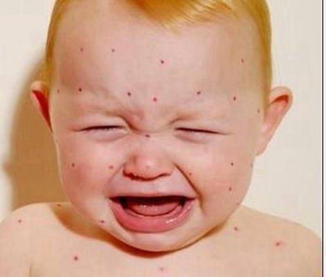 嬰兒蕁麻疹 (43) 