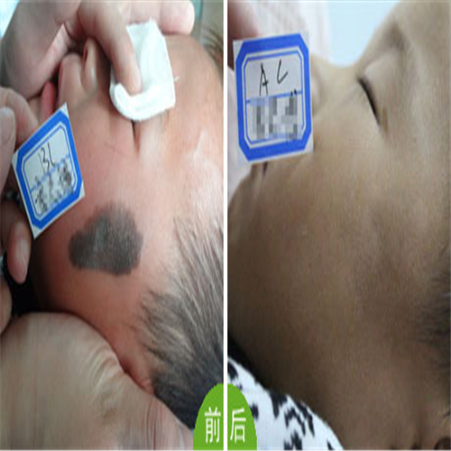 皮脂腺痣前後對比
