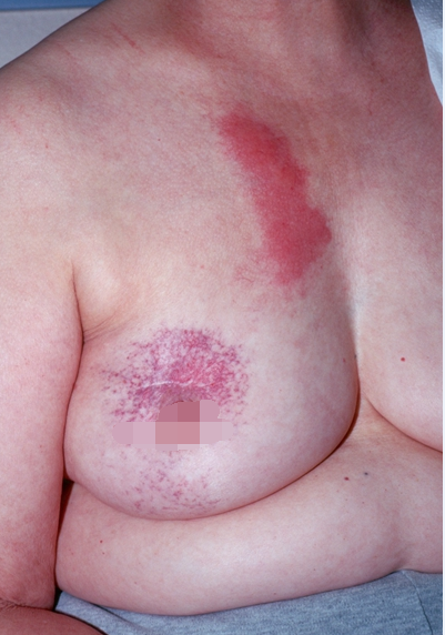 乳房溼疹 (37) 