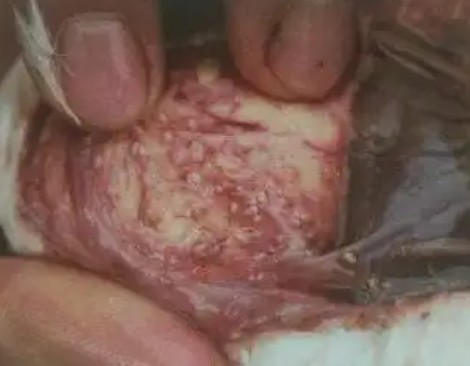 小兒外陰皮膚念珠菌病