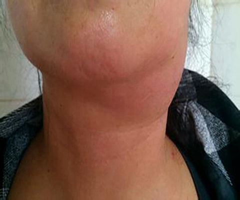 頜下淋巴結腫大