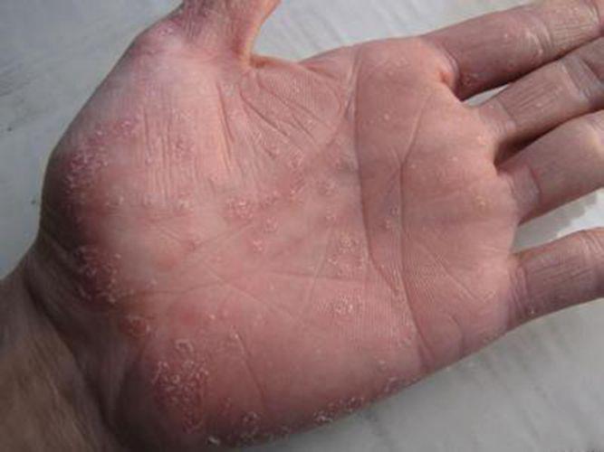 手部溼疹脫皮