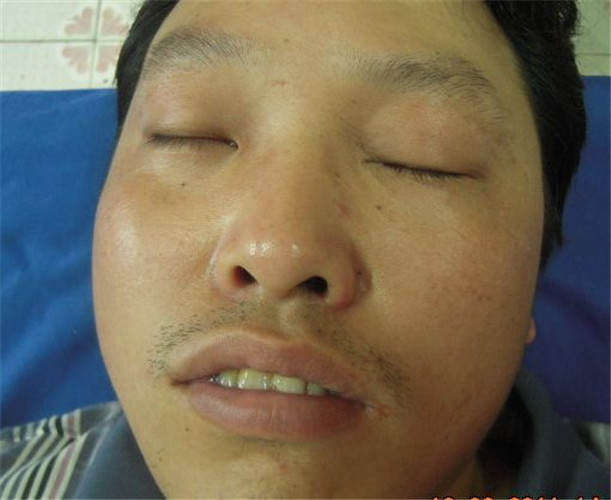 推拿面癱治療方法的