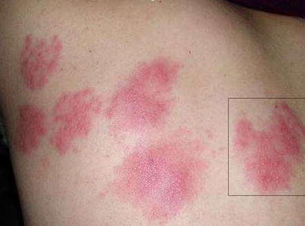 身體蟎蟲過敏症狀