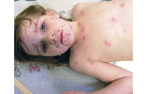 長水痘的症狀 (51) 